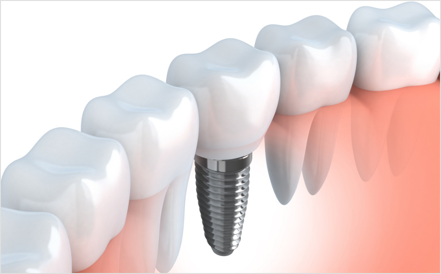 Graphic of dental implants in dallas, tx