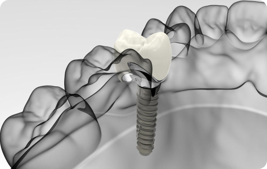 Illustration of how dental implants work and look