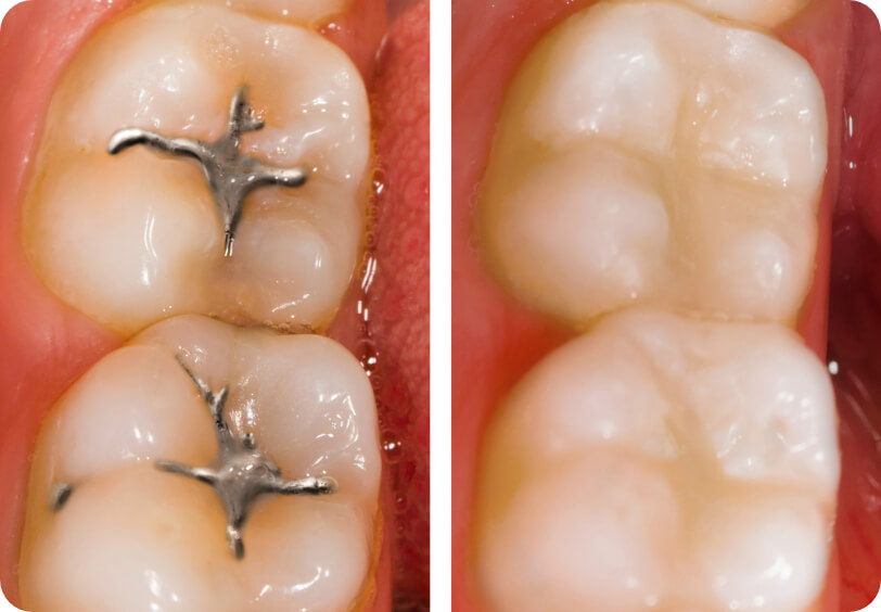 before and after dental fillings at our Dallas dentistry