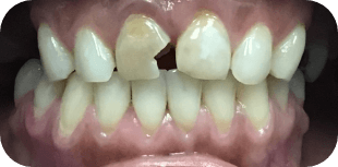 Patient-04- before