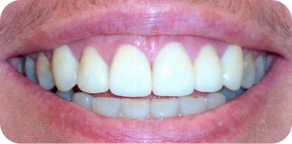 before and after photo taken by top rated cosmetic dentist in dallas, tx