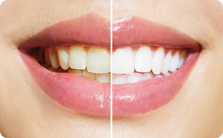 before and after teeth whitening at our family dentistry in Dallas