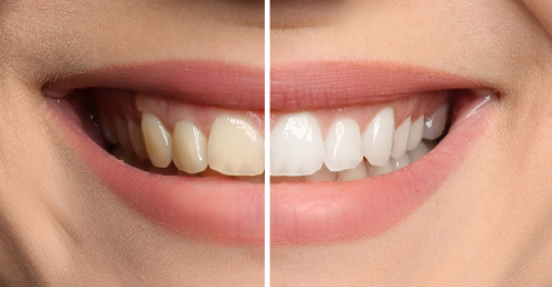 Before and after at-home teeth whitening by our cosmetic dentist in Dallas